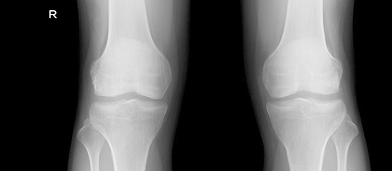 膝の半月板損傷の診断
