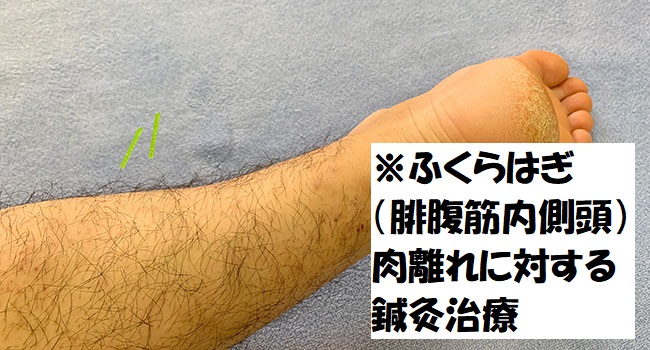 知らなきゃ損 肉離れの新常識 正しい常識 痛い辛い寝られない再発防止に鍼灸治療が効果的 やまもとじょうじのみちのく鍼灸道