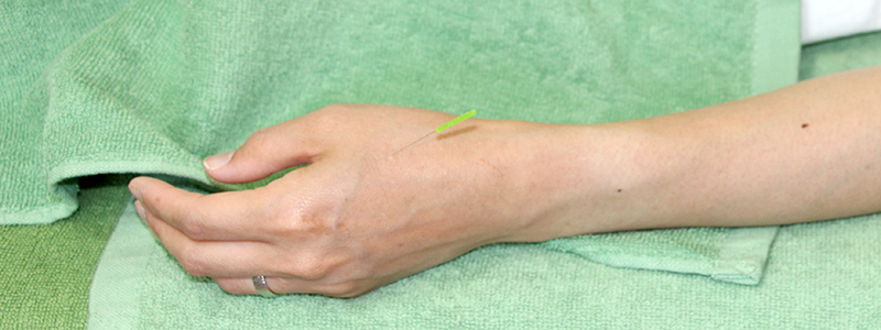 手のしびれの鍼灸治療