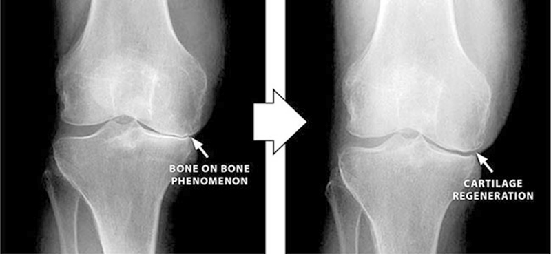 再生医療のPRP療法後の膝関節
